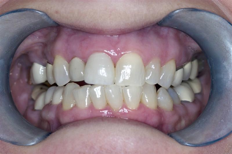 what teeth look like before laser gum surgery in Kentucky, not osseous, LANAP patient friendly FDA approved